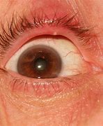 Image result for Pimple On Lower Eyelid