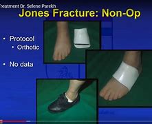 Image result for Jones Fracture Treatment