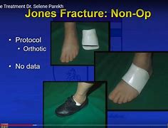 Image result for Jones Fracture Brace