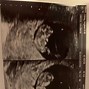 Image result for Hiding Twin Ultrasound
