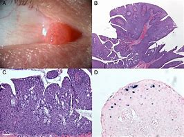Image result for Post Operated Conjunctival Papilloma