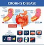 Image result for Small Bowel Crohn's Disease