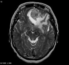 Image result for Atypical Meningioma