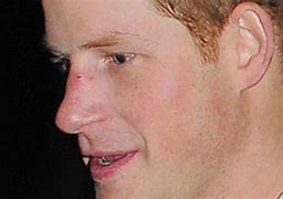 Image result for Prince Harry Nose