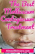 Image result for Molluscum Contagiosum On Face Treatment