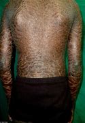 Image result for Rare Human Skin Disease