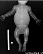 Image result for axondroplasia