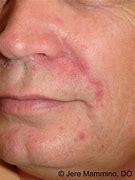 Image result for Perioral Dermatitis around Nose