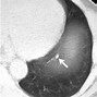 Image result for 7 mm Lung Nodule