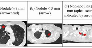 Image result for 1 7 Cm Nodule in Lung