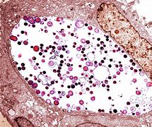 Image result for Chlamydia Trachomatis Images Microscope