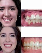 Image result for Invisalign Crowding Before and After