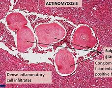 Image result for actinomuces