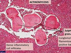 Image result for actknomicosis
