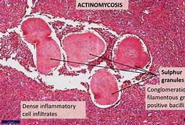Image result for ac5inomicosis