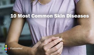 Image result for 10 Most Common Diseases