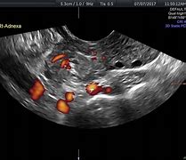 Image result for Ultrasound Ovarian Torsion with Cyst