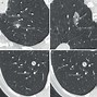 Image result for 16Mm Lung Nodule