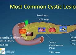 Image result for 5 Cm Cyst On Kidney
