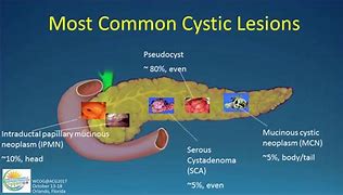 Image result for 10 Cm Kidney Cyst