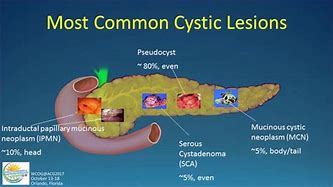 Image result for Cyst 10Cm