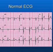 Image result for What Does CPR Look Like On EKG