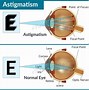 Image result for Astigmatism Pic