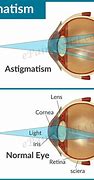 Image result for Astigmatism Eye Look Like
