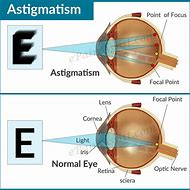Image result for Astigmatism Text