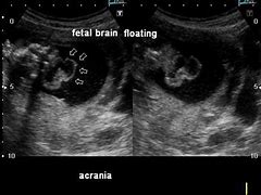Image result for Acrania Fetal Ultrasound