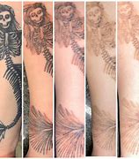 Image result for Tattoo Removal