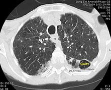 Image result for CT Scan of Valley Fever in Lung