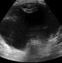 Image result for Ovarian Cancer On Ultrasound
