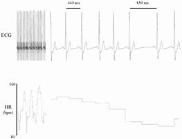 Image result for Heart Rate Variation