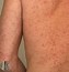 Image result for What Does Scabies Look Like