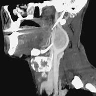 Image result for Carotid Tumor Neck