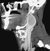 Image result for Carotid Artery Tumor