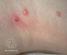 Image result for Molluscum Behind Knee in Toddler