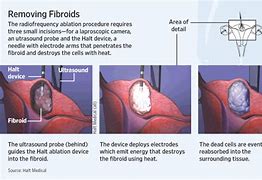 Image result for Treatments for Uterine Fibroids
