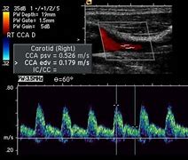 Image result for Carotid Artery Occlusion