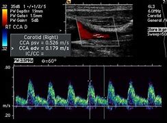 Image result for Carotid Stenosis Ratio Ultrasound