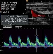 Image result for Carotid Artery Occlusion Ultrasound