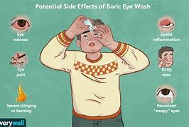 Image result for Boric Acid Eyes