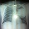 Image result for Pulmonary Opacity