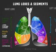 Image result for Lung Tumor Size