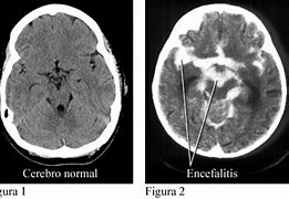 Image result for encefalimielitis
