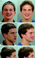 Image result for Cleft Jaw