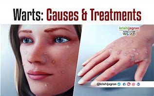 Image result for What Causes Skin Warts