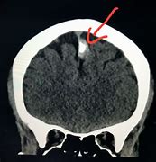 Image result for 9Mm Lesion