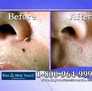 Image result for Wart Freeze On a Mole